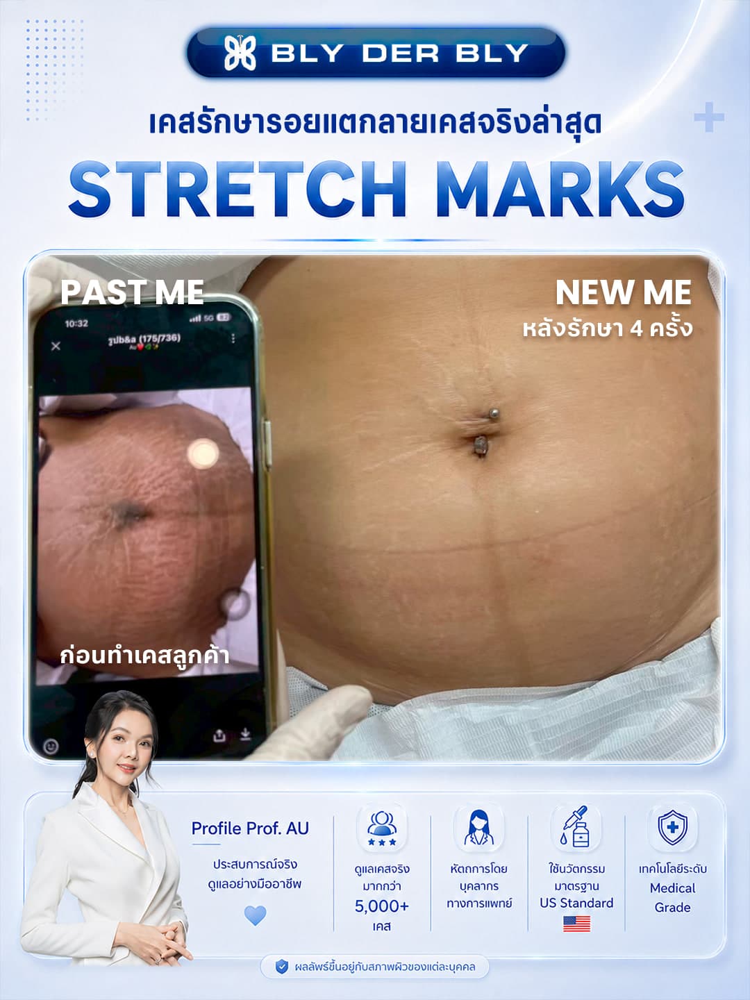 ภาพเปรียบเทียบรอยแตกลายบริเวณหน้าท้อง ก่อนดูแลและหลังดูแล 4 ครั้ง