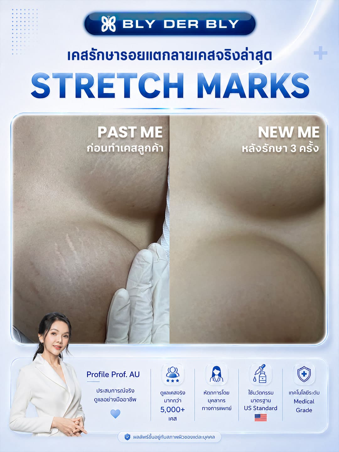 ภาพเปรียบเทียบรอยแตกลายบริเวณหน้าท้อง ก่อนดูแลและหลังดูแล 3 ครั้ง