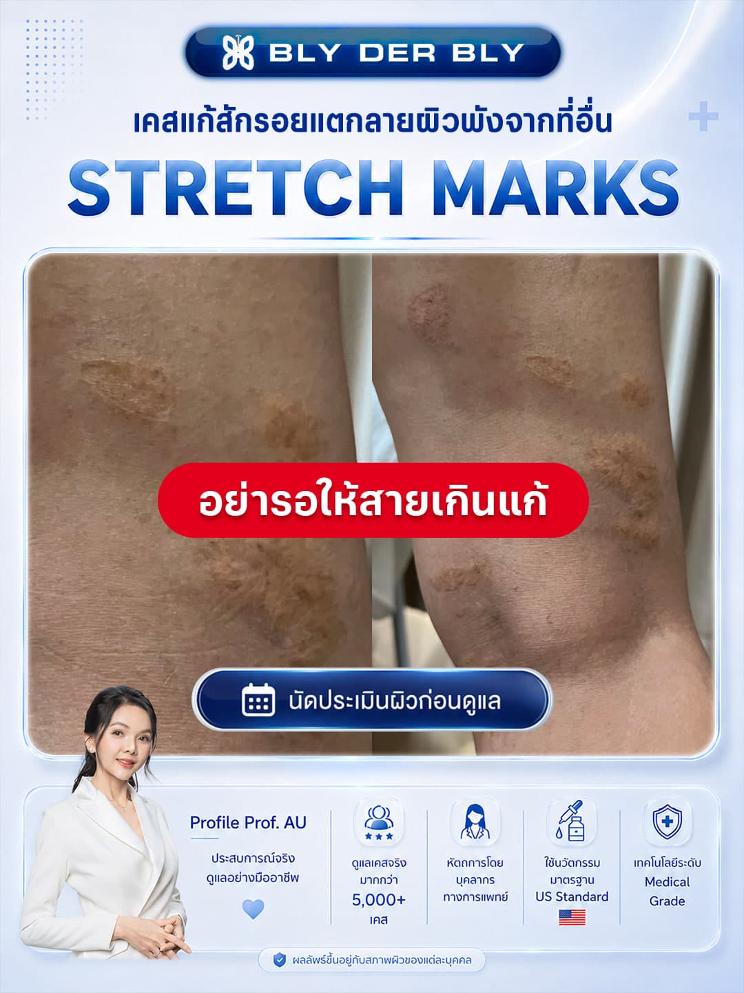 ภาพเคสรอยแตกลายสำหรับประเมินสภาพผิวก่อนวางแผนรายบุคคล